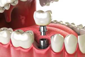 3D illustration of a dental implant or prosthesis. New teeth, tooth replacement and modern dentistry / medicine concept.