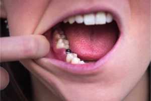 Single tooth implant. Young woman without tooth on lower jaw. Missing tooth. Implant after tooth extraction